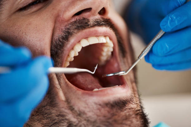 Best Emergency Dental Care for Broken or Chipped Teeth in Moyie Springs, ID